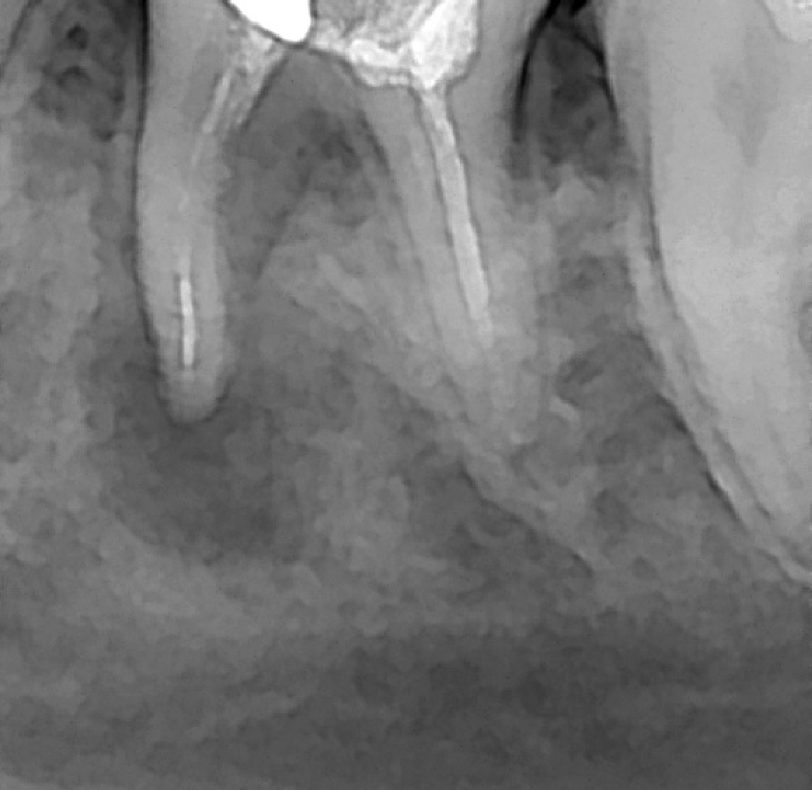 Realizamos una radiografía periapical para obtener mayor definición de la lesión del quiste y su extensión.